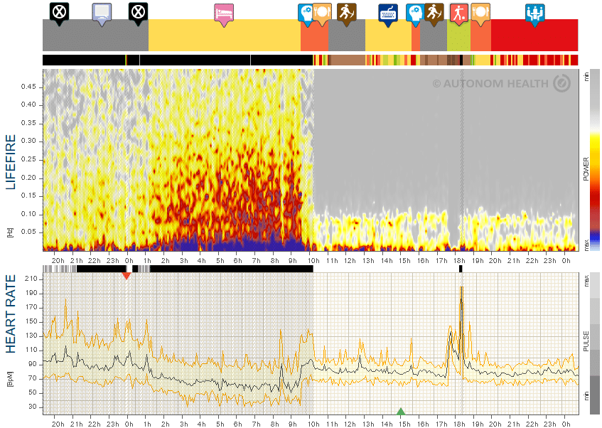 Fig. 20: Mr. S., 65, transient atrial fibrillation