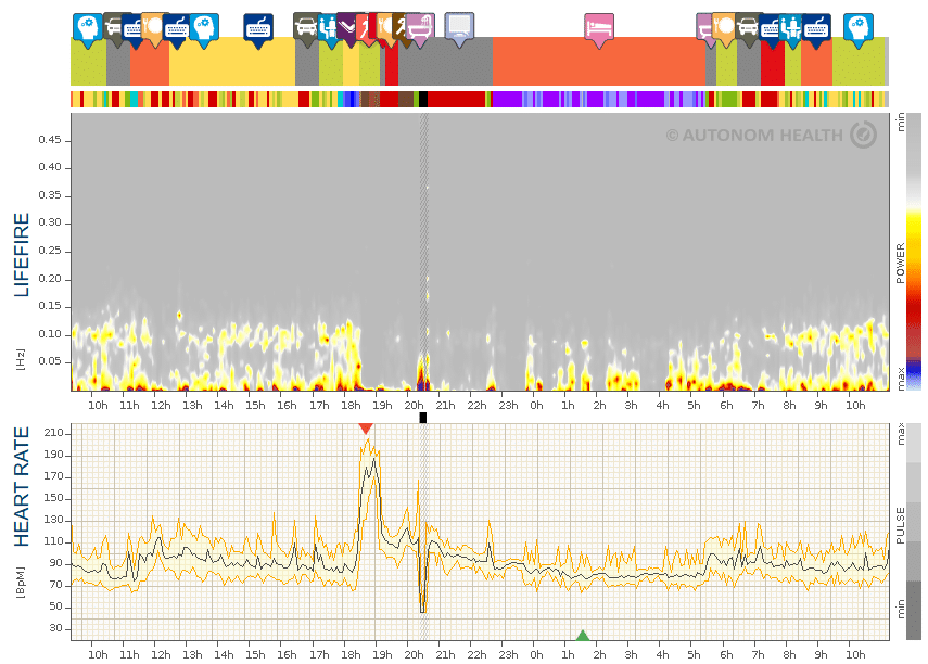 Fig. 17: Amateur athlete, 31, overtraining